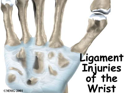 Ligament Injuries of the Wrist