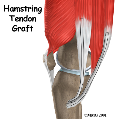 Hamstring Tendon Graft Reconstruction of the ACL